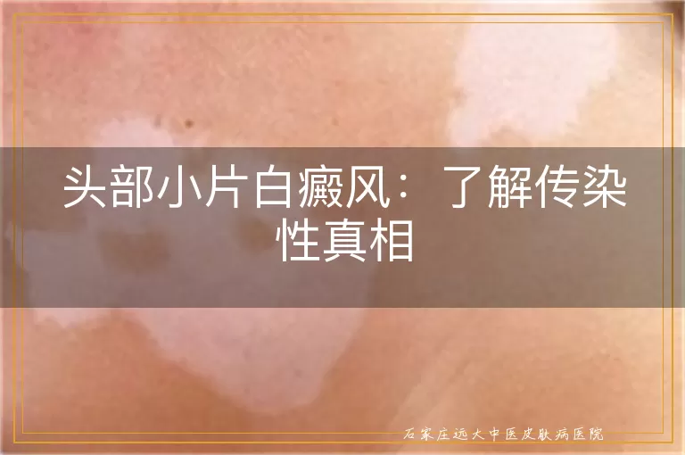 头部小片白癜风：了解传染性真相