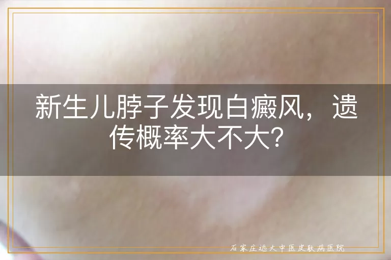 新生儿脖子发现白癜风，遗传概率大不大？