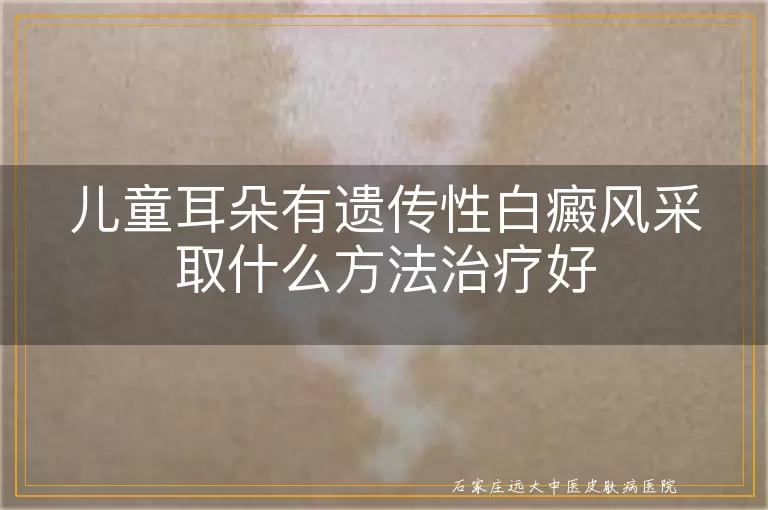 儿童耳朵有遗传性白癜风采取什么方法治疗好
