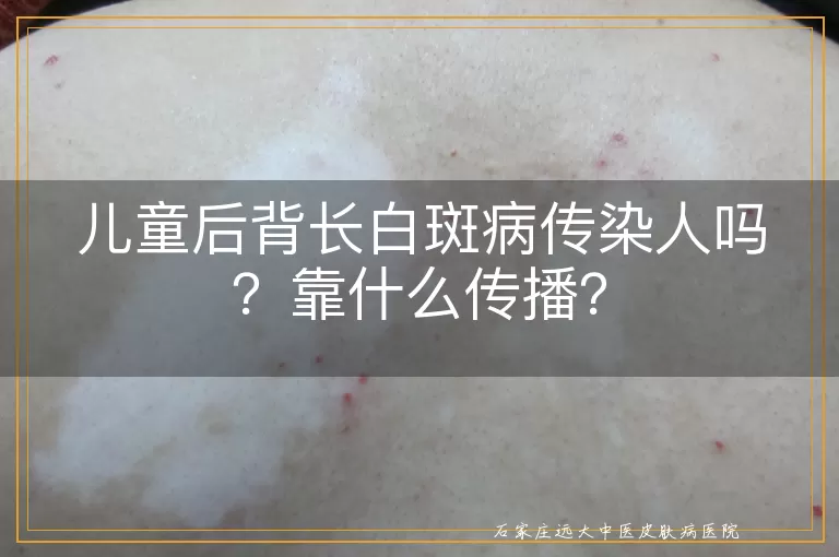儿童后背长白斑病传染人吗？靠什么传播？