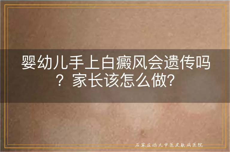 婴幼儿手上白癜风会遗传吗？家长该怎么做？
