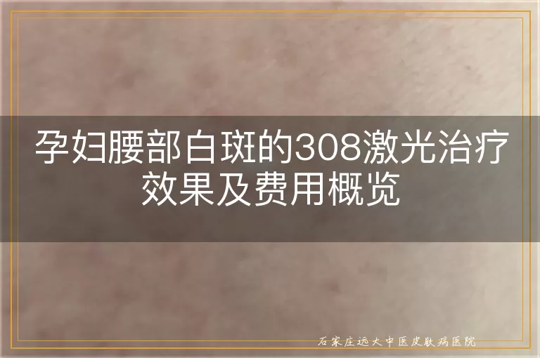 孕妇腰部白斑的308激光治疗效果及费用概览
