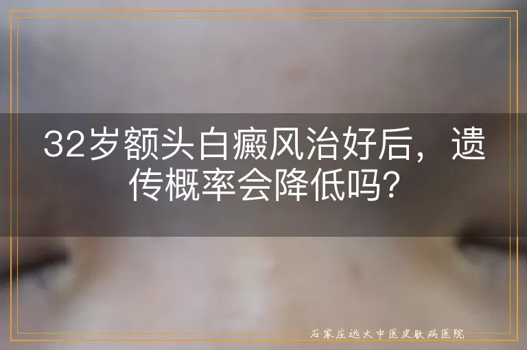 32岁额头白癜风治好后，遗传概率会降低吗？