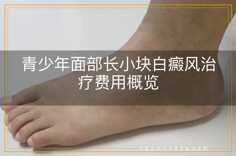 青少年面部长小块白癜风治疗费用概览