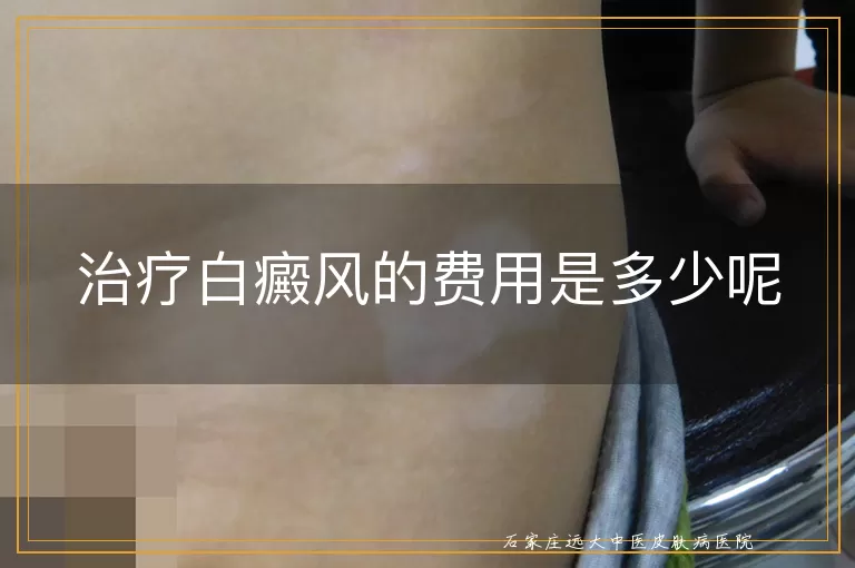 治疗白癜风的费用是多少呢