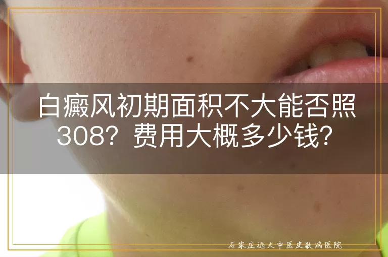 白癜风初期面积不大能否照308？费用大概多少钱？