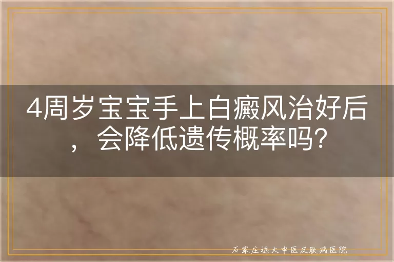 4周岁宝宝手上白癜风治好后，会降低遗传概率吗？