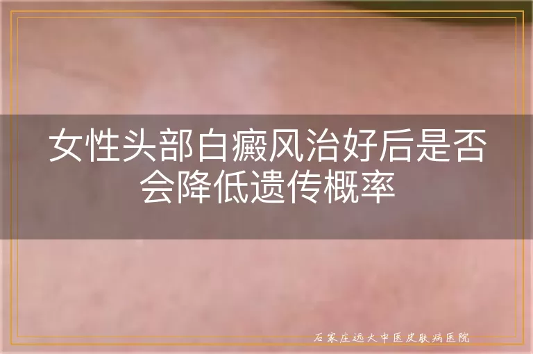女性头部白癜风治好后是否会降低遗传概率