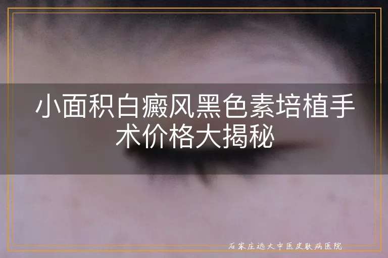 小面积白癜风黑色素培植手术价格大揭秘