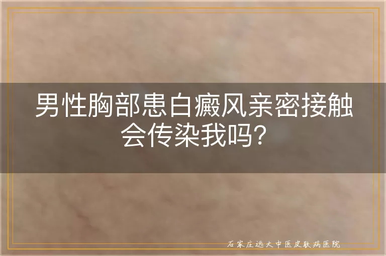 男性胸部患白癜风亲密接触会传染我吗？