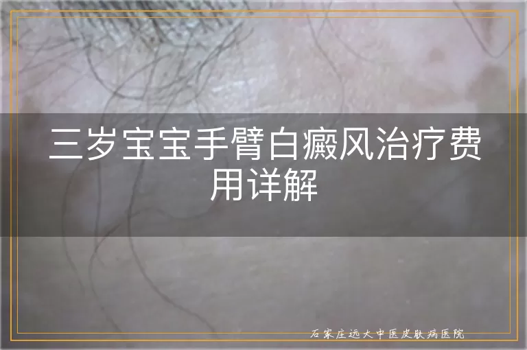 三岁宝宝手臂白癜风治疗费用详解