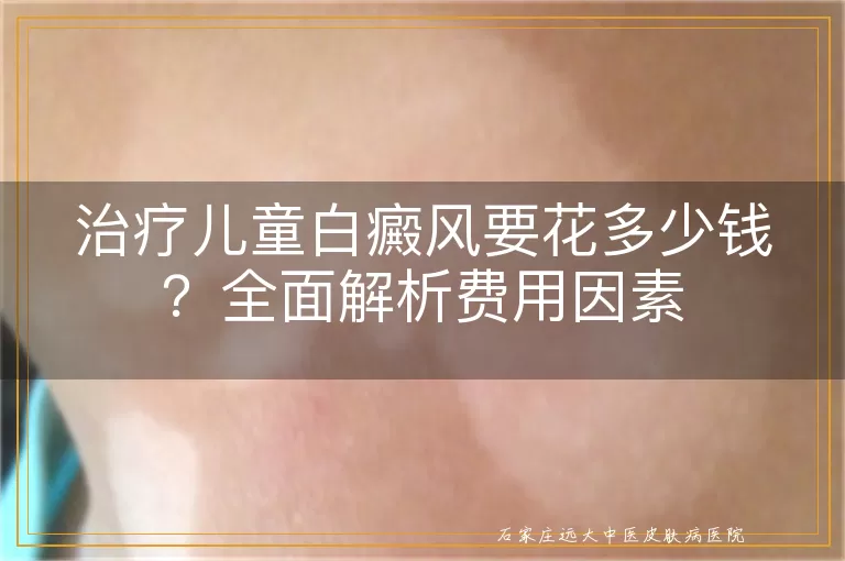 治疗儿童白癜风要花多少钱？全面解析费用因素