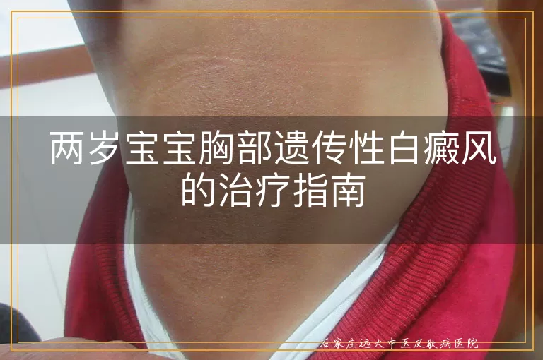 两岁宝宝胸部遗传性白癜风的治疗指南