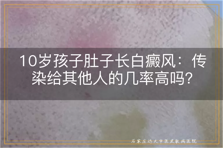 10岁孩子肚子长白癜风：传染给其他人的几率高吗？