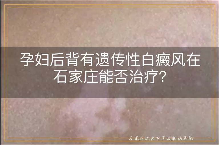 孕妇后背有遗传性白癜风在石家庄能否治疗？