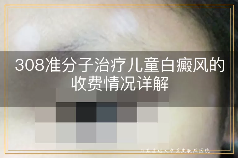 308准分子治疗儿童白癜风的收费情况详解