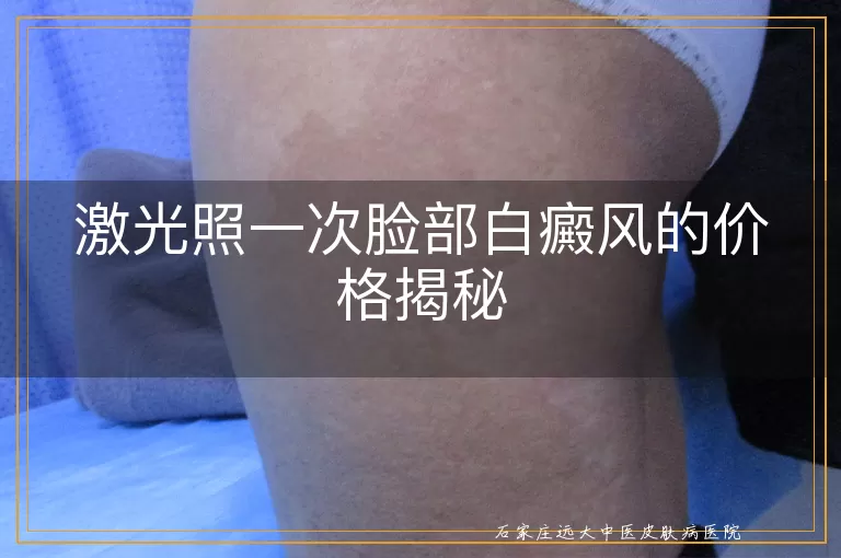 激光照一次脸部白癜风的价格揭秘