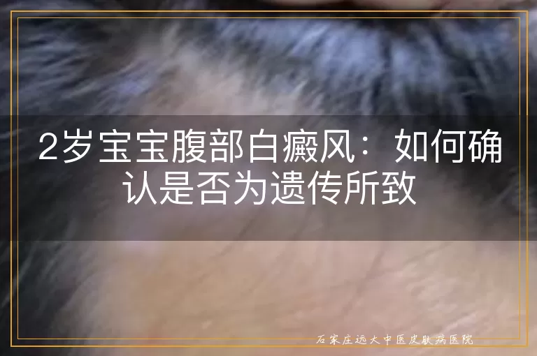 2岁宝宝腹部白癜风：如何确认是否为遗传所致