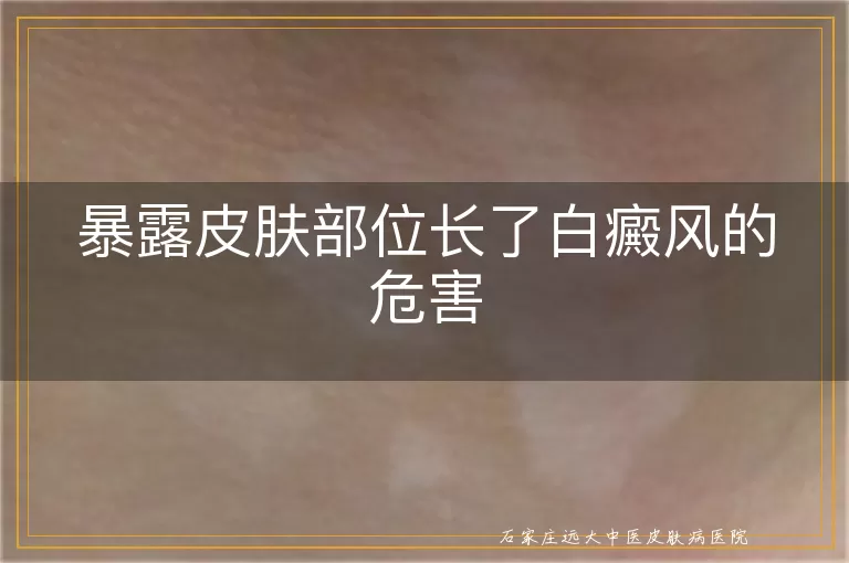 暴露皮肤部位长了白癜风的危害