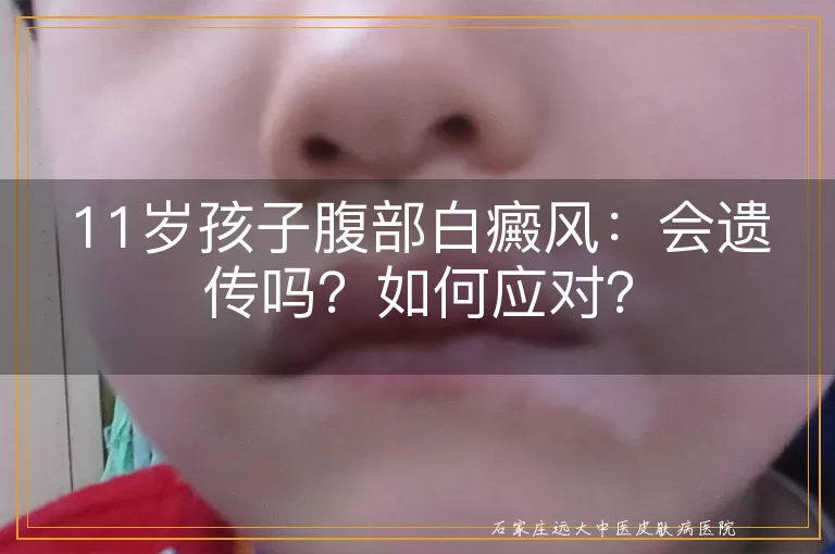 11岁孩子腹部白癜风：会遗传吗？如何应对？