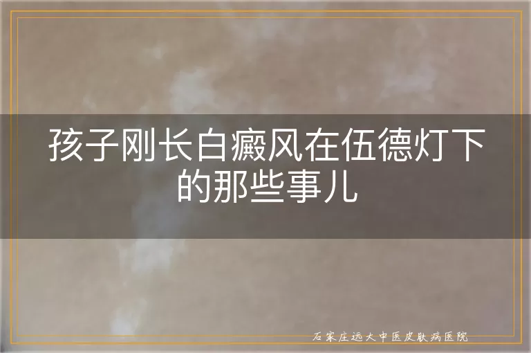 孩子刚长白癜风在伍德灯下的那些事儿