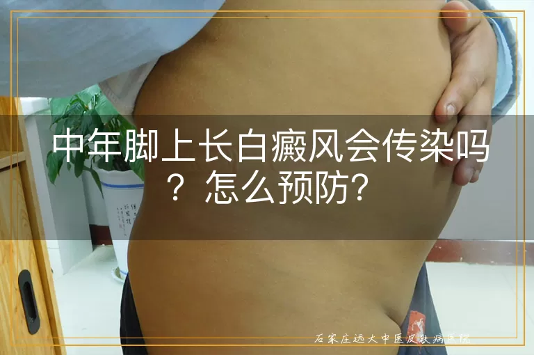 中年脚上长白癜风会传染吗？怎么预防？