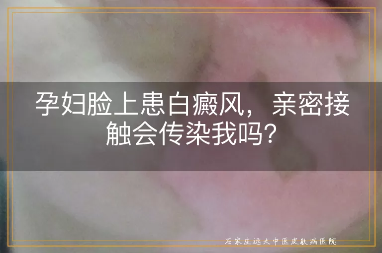 孕妇脸上患白癜风，亲密接触会传染我吗？