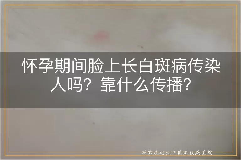 怀孕期间脸上长白斑病传染人吗？靠什么传播？