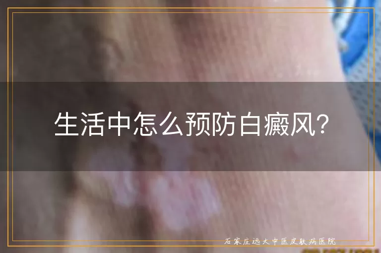 生活中怎么预防白癜风？