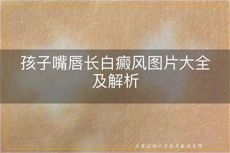 孩子嘴唇长白癜风图片大全及解析