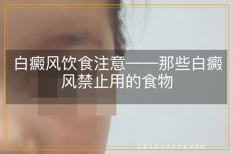 白癜风饮食注意——那些白癜风禁止用的食物