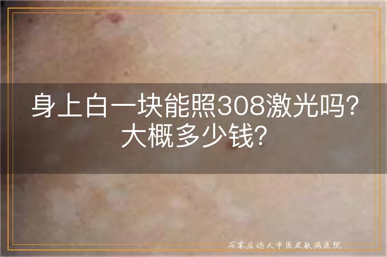 身上白一块能照308激光吗？大概多少钱？