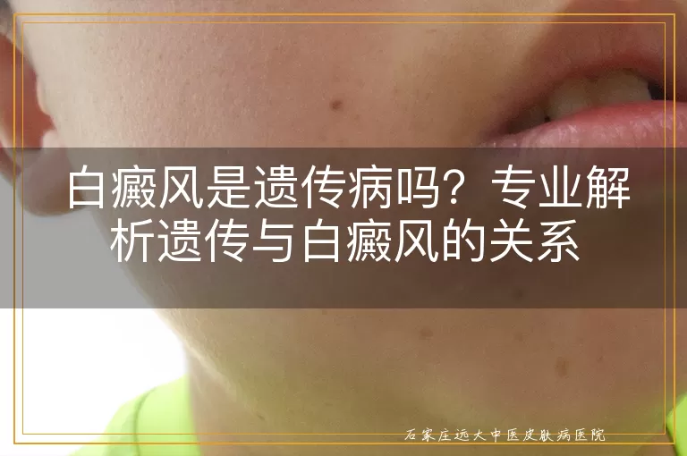 白癜风是遗传病吗？专业解析遗传与白癜风的关系