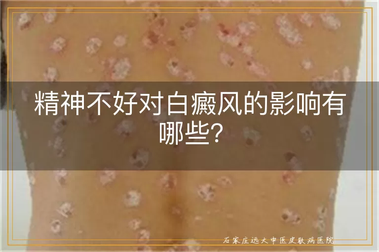 精神不好对白癜风的影响有哪些？