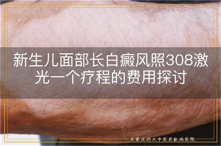 新生儿面部长白癜风照308激光一个疗程的费用探讨