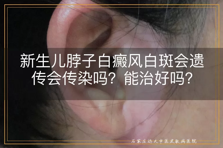 新生儿脖子白癜风白斑会遗传会传染吗？能治好吗？