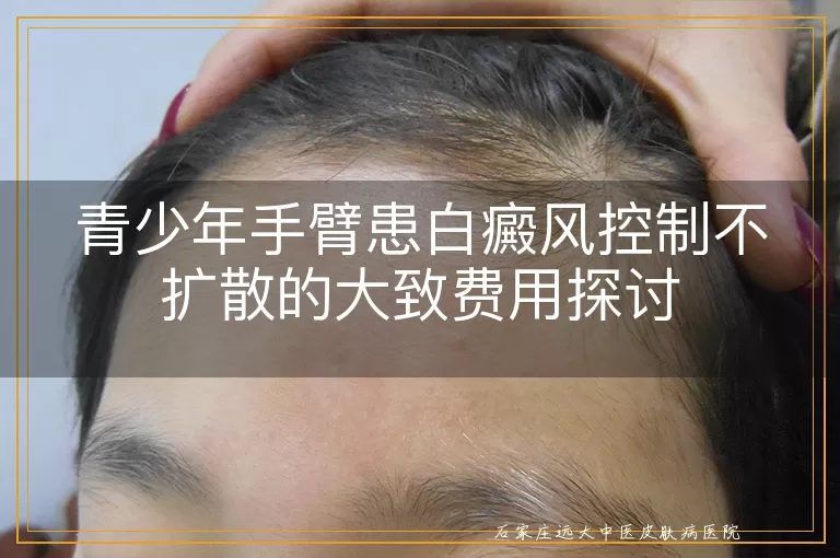 青少年手臂患白癜风控制不扩散的大致费用探讨