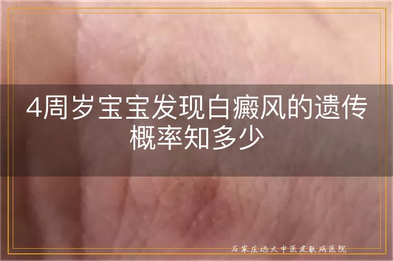 4周岁宝宝发现白癜风的遗传概率知多少