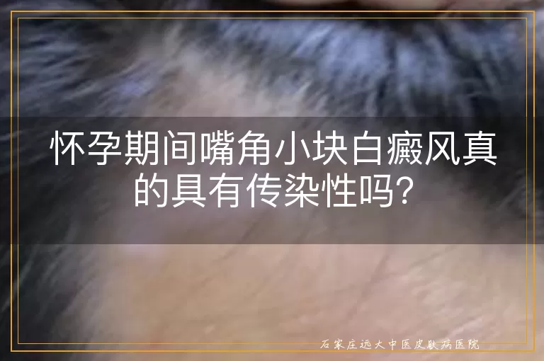 怀孕期间嘴角小块白癜风真的具有传染性吗？