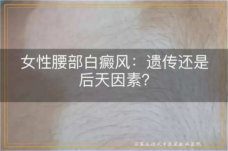 女性腰部白癜风：遗传还是后天因素？
