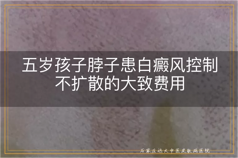 五岁孩子脖子患白癜风控制不扩散的大致费用