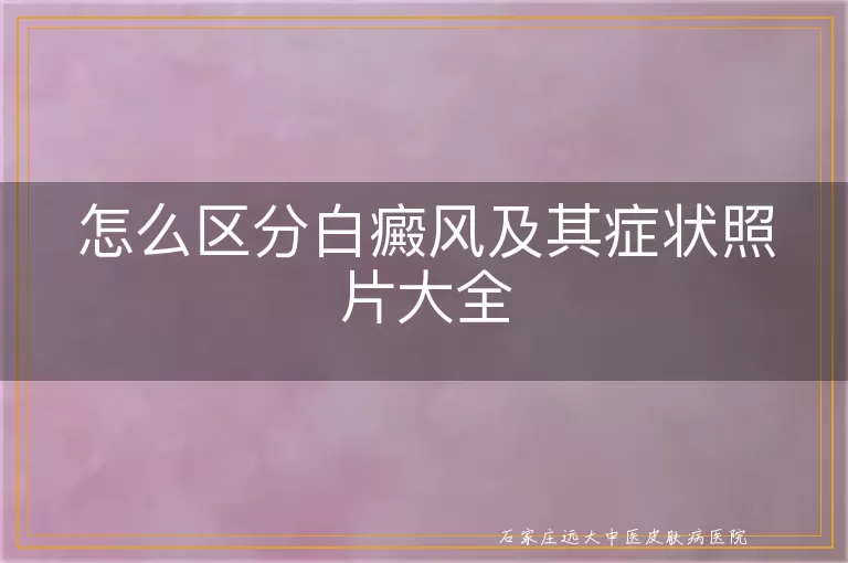 怎么区分白癜风及其症状照片大全