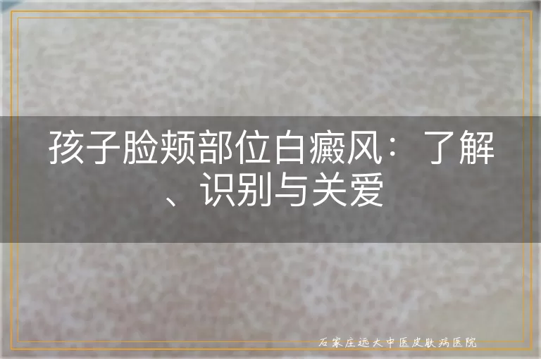 孩子脸颊部位白癜风：了解、识别与关爱