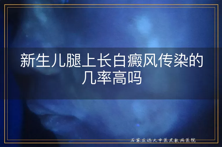 新生儿腿上长白癜风传染的几率高吗