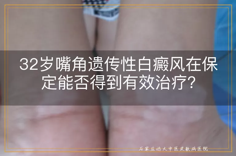 32岁嘴角遗传性白癜风在保定能否得到有效治疗？