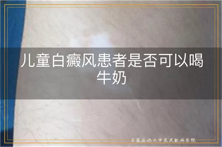 儿童白癜风患者是否可以喝牛奶
