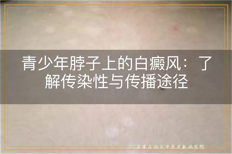 青少年脖子上的白癜风：了解传染性与传播途径