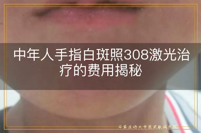 中年人手指白斑照308激光治疗的费用揭秘