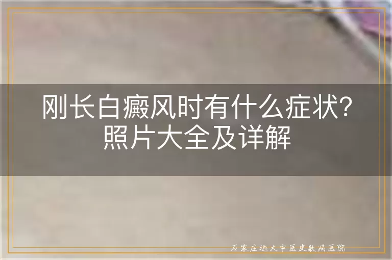 刚长白癜风时有什么症状？照片大全及详解