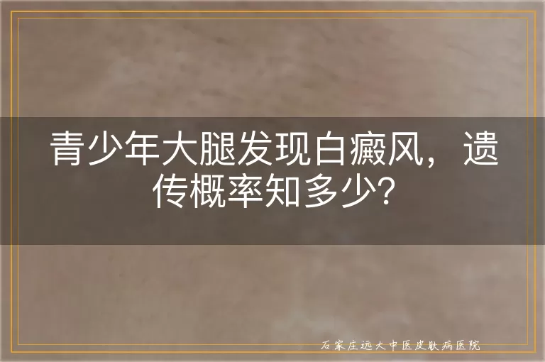 青少年大腿发现白癜风，遗传概率知多少？
